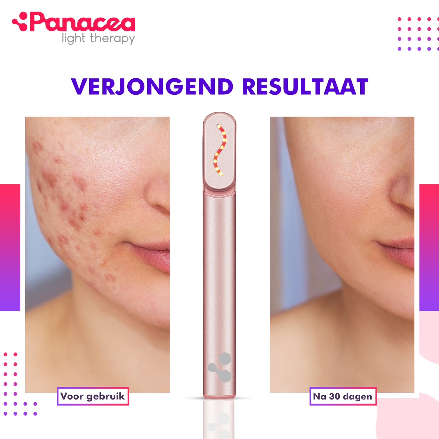 PerfectSkin 630nm Red Light Therapy Wand Anti-Age en Huidzuiverend