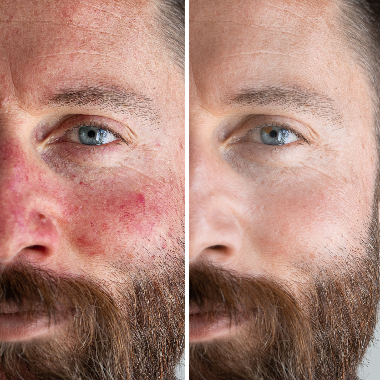Rosacea LED Light Masker Gezichtsmasker
